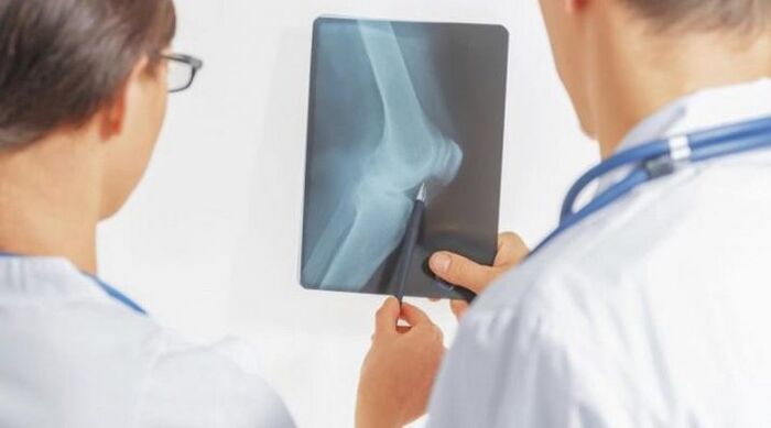 Po nezbytné diagnostice artrózy kolenního kloubu lékaři předepisují komplexní léčbu