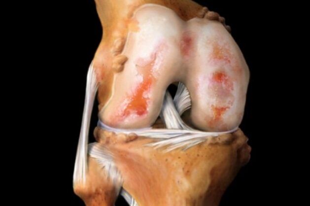Zničení kolenního kloubu v důsledku artrózy - běžná patologie pohybového aparátu