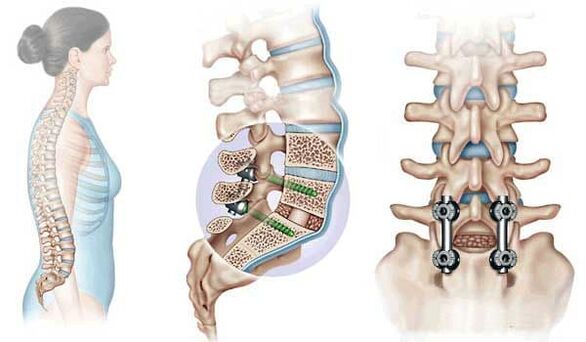 Fixace posunutých obratlů implantáty v pokročilém stadiu osteochondrózy
