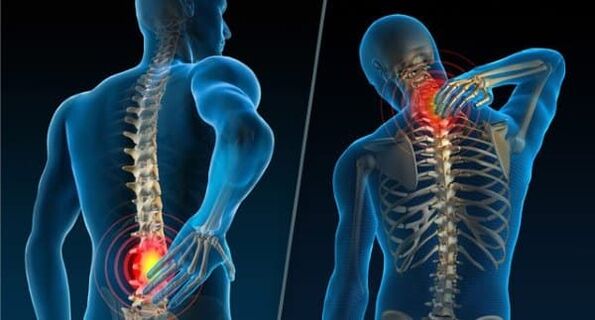 Známky indikující vývoj osteochondrózy - bolest v krku a dolní části zad