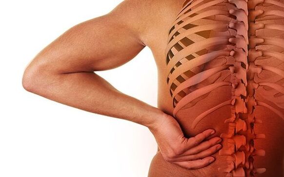 Bolest je hlavním neurologickým příznakem spinální osteochondrózy