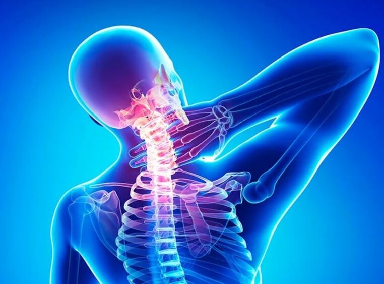 Osteochondroza krční páteře