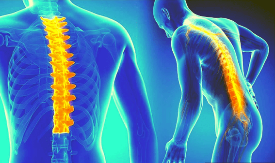 Osteochondroza páteře