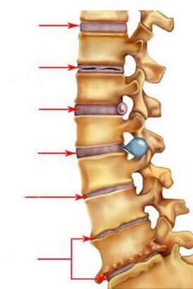 Jak se vyvíjí osteochondróza