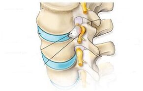 hlavní příznaky cervikální osteochondrózy