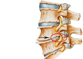 příčiny cervikální osteochondrózy