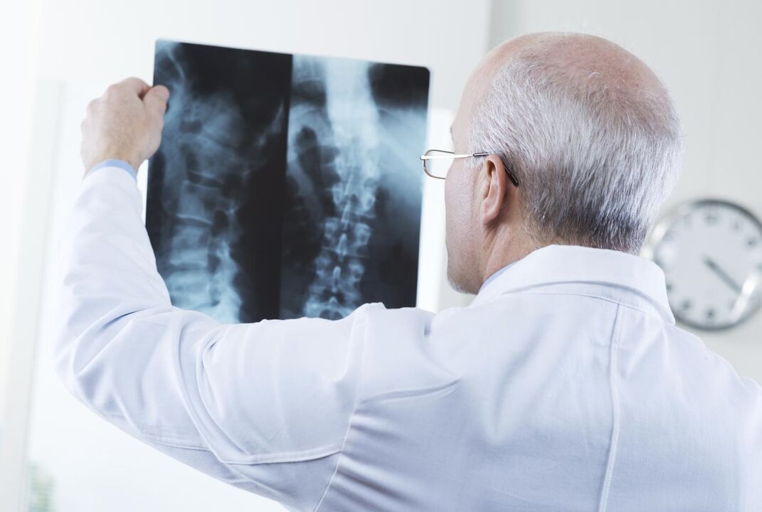 lékař zkoumá snímek krční páteře s osteochondrózou