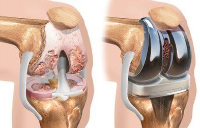 Endoprotetika kolenního kloubu s gonartrózou
